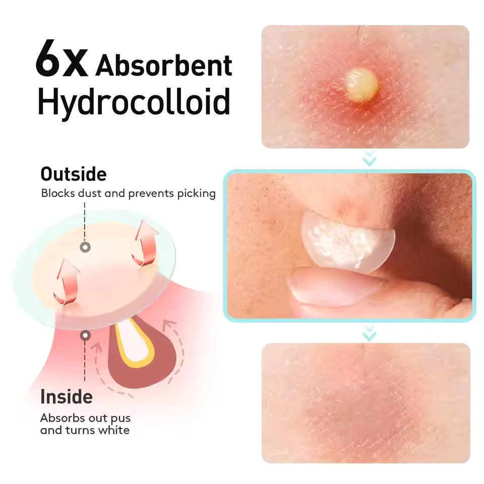 360 pieces/box acne patches -  - Face Oil ulasan dan harga
